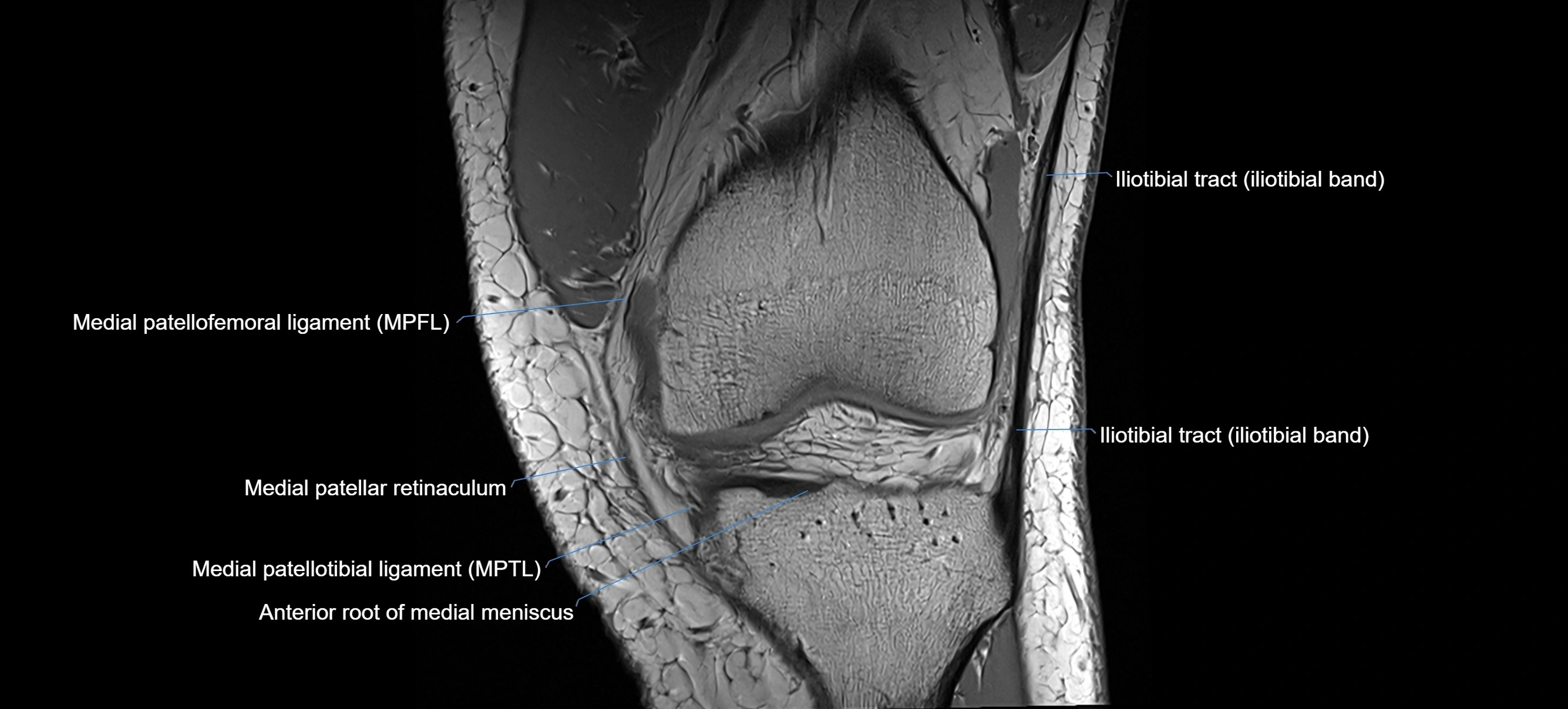 MRI coronal  ligaments cross sectional anatomy 3T  radiology  image-img-04001-00013.webp